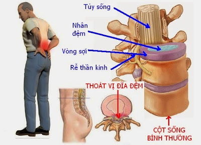 cáy chỉ chữa thoát vị đĩa đệm